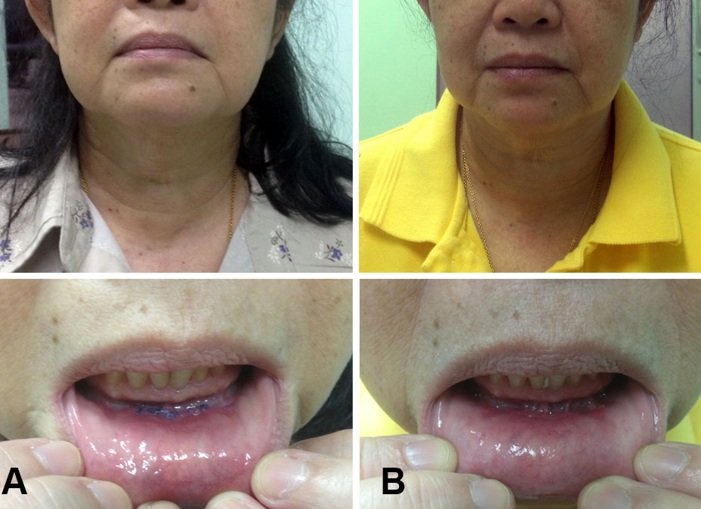 แผลในช่องปากหลังผ่าตัด TOETVA ที่ 1 สัปดาห์ (A) และ 6 สัปดาห์ (B) แผลหายเกือบสนิทมองแทบไม่เห็น